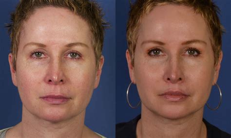 John Hilinski MD Blog San Diego CA