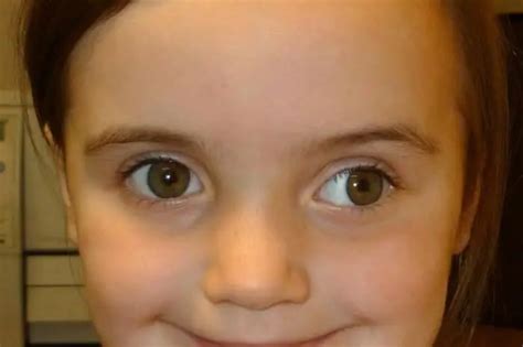 Squint: causes, symptoms, diagnosis and treatment | Vision 2024