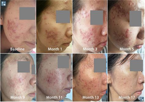 Fungal Acne and Common Acne 真菌粉刺与寻常痤疮 - TANGS CLINICAL TCM