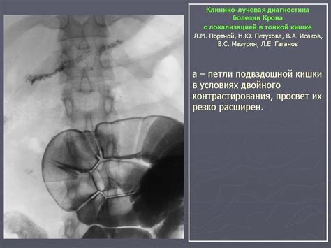 Крона болезнь. + | Портал радиологов