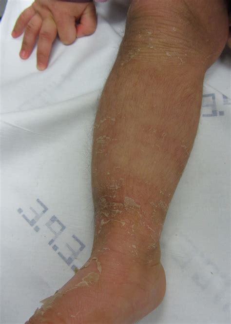 Ichthyosis Bullosa Of Siemens