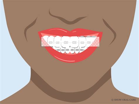 Can You Use Teeth Whitening Strips with Braces? Smile Guide!