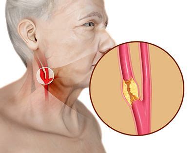Carotid Artery Disease | Macon, GA | Premier Vascular Surgery Group