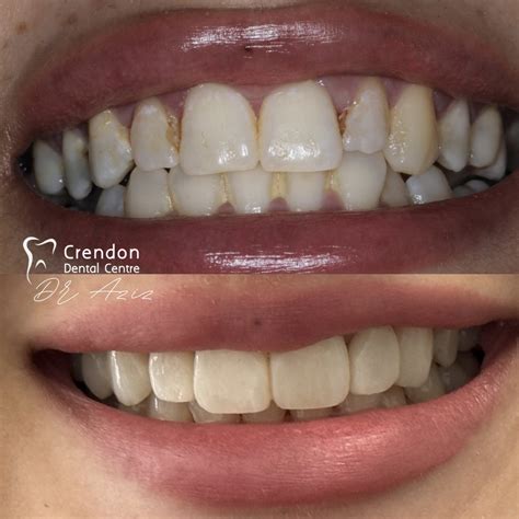 Composite Bonding | Dentist High Wycombe | Dental Implants 