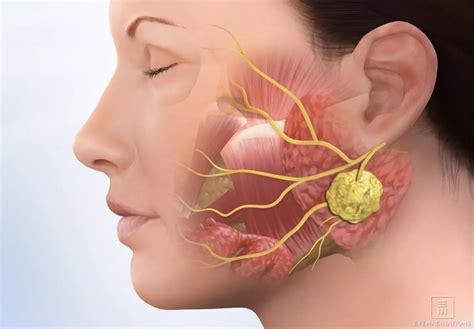 decoding parotid gland swelling   solutions parotid gland