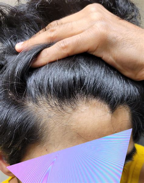 Scalp biopsy results - Lichen planopilaris : tressless