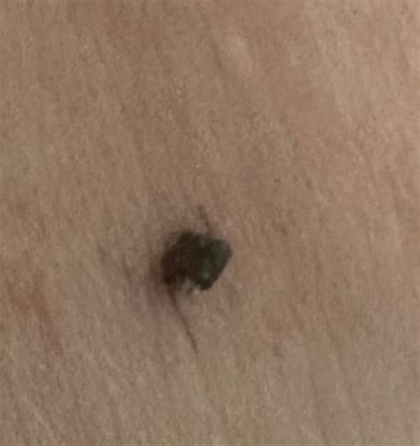 5 Subtle Signs You Might Have Been Bitten By A Tick