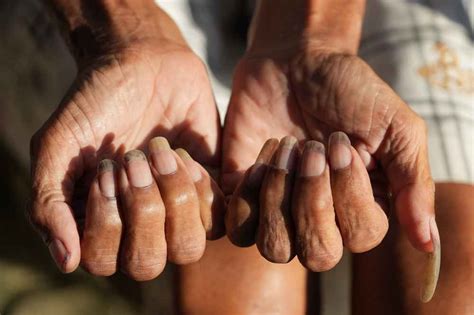 5 Ciri Kuku Orang Sakit Jantung yang Perlu Diperhatikan - Hello Sehat