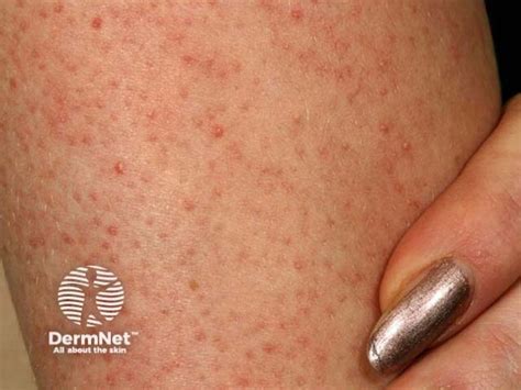 keratosis pilaris csirkebor webbeteg