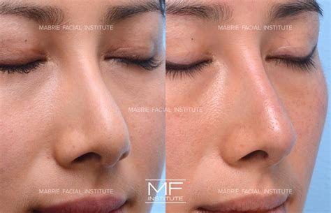 4 Ways To Make Your Nose Appear Smaller With Filler | Mabrie Facial