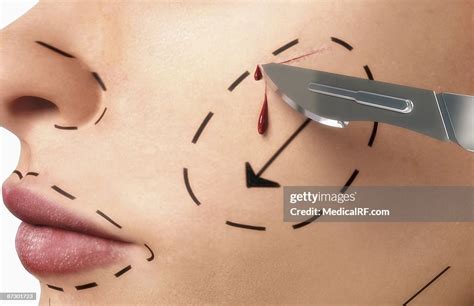 Rhytidectomy High-Res Vector Graphic - Getty Images