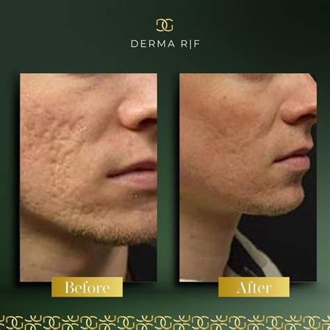 Derma Radio Frequency R|F | Derma Group Ltd
