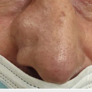 image showing   mass    side wall   nose