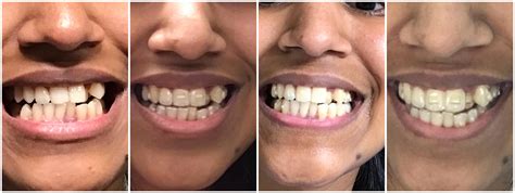 Tray 1, Tray 3,Tray 4 and Tray 5 Progress : r/Invisalign