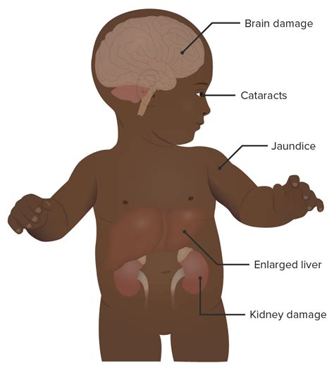 Galactosemia Baby Galactosemia