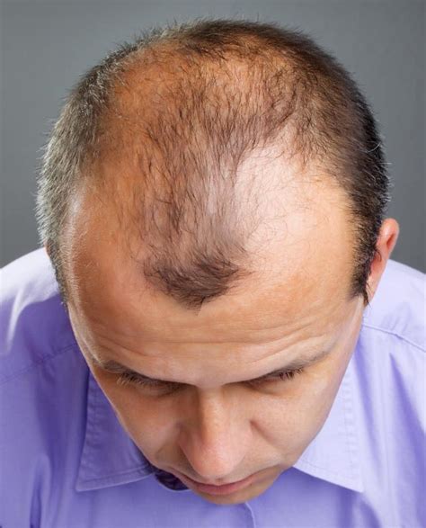 hairstyles  thinning hair