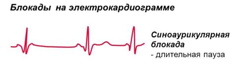 Синоаурикулярная блокада — CardioWiki