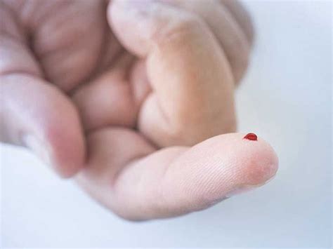 hematidrosis sweating blood   treatment