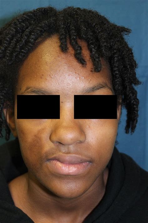 Morphea – Digital Dermatology Atlas