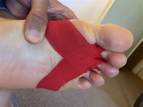 Foot Extensor Tendonitis Taping at Rosa Vega blog