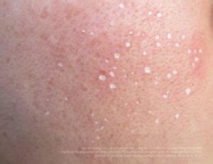TCA Cross Scar Therapy | Radium Medical Aesthetics Singapore