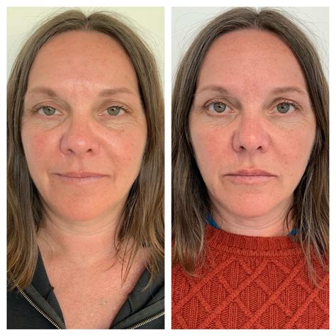dermal fillers   patient  refine anti aging