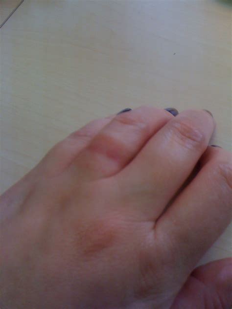 itchy finger  wedding ring  faith fussell blog