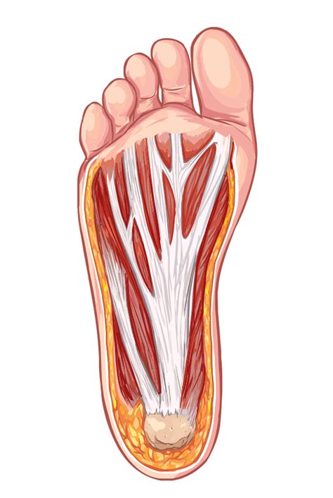 Fascite plantar: Entenda causas, tratamentos e o diagnóstico