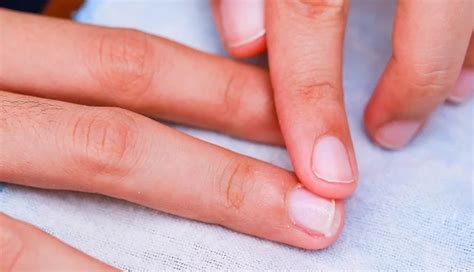 3 Effective Tips to Treat and Avoid Hangnails - lifeberrys.com