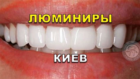 Люминиры (голливудские виниры) в стоматологии, Киев Украина (видео ...