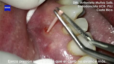 Fistulografía - YouTube