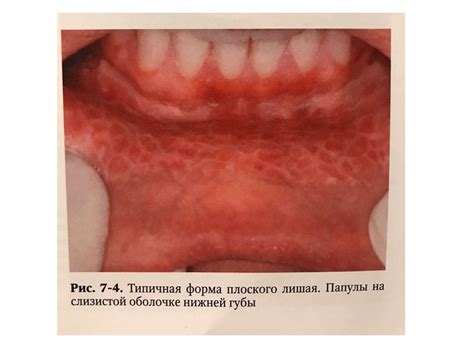 Изменения слизистой оболочки рта при дерматозах. Красный плоский лишай ...