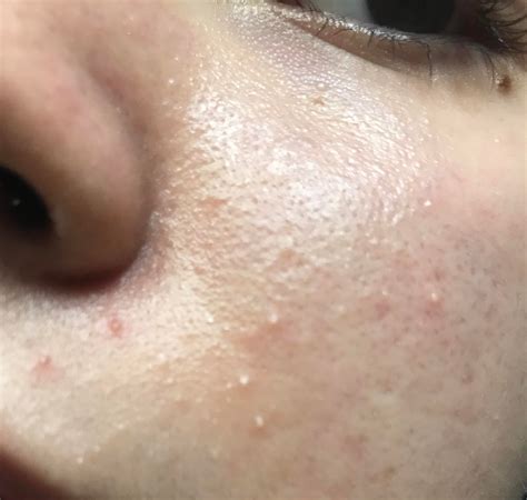 small white bumps on face 2