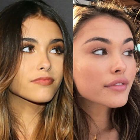Madison Beer plastic surgery | Botox lips, Lip fillers, Cheek fillers