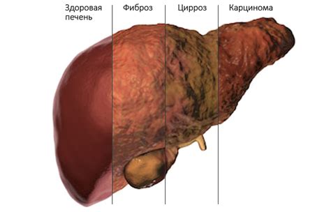 Фиброз печени: причины, симптомы, диагностика, лечение | Фосфоглив