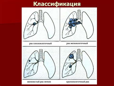 Рак легкого - презентация онлайн