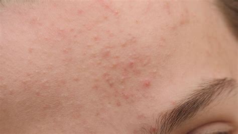whiteheads acne treatment nyc mount sinai  york