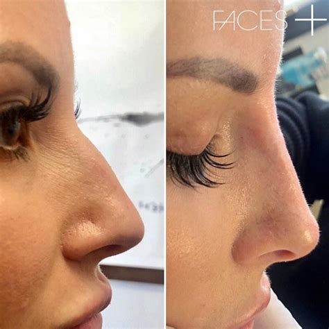 filler nose job before and after - Just As Much Fun Log-Book Diaporama