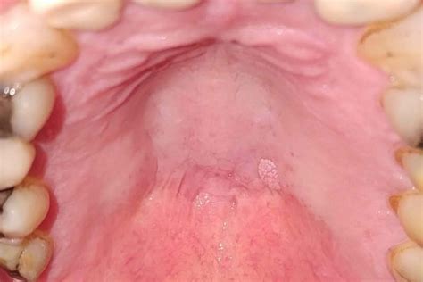 Early Signs Of Mouth Cancer Reddit - Infoupdate.org