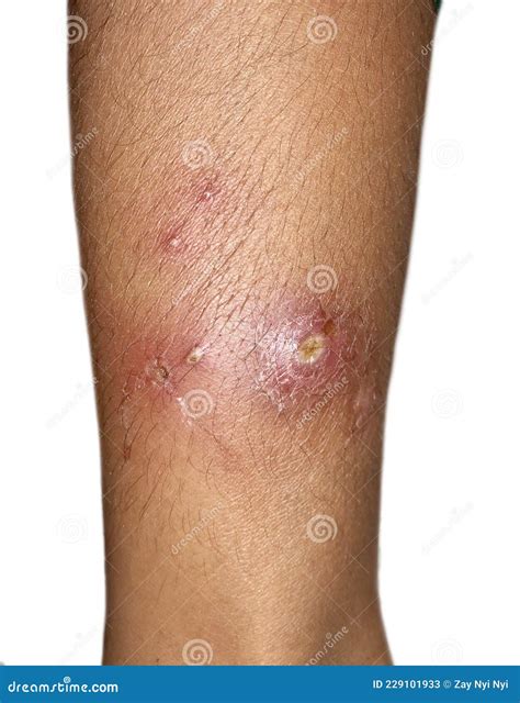 Furuncles or Staphylococcal Infection in Leg of Asian Child Stock Image
