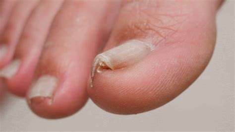 What Should You Do About an Ingrown Toenail? | Advanced Ankle & Foot