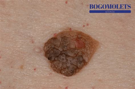 Кератома лікування у Києві, ціна, фото, відгуки | BOGOMOLETS CLINIC