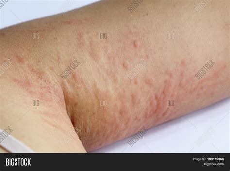 rash   upper arm  john jessep blog