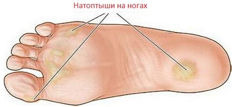Мази, крема и средства от натоптышей на ногах: как использовать и применять