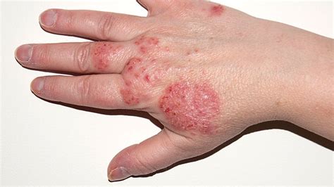What is Rash: Types, Causes, Symptoms and Treatment ? Find Treatment ...