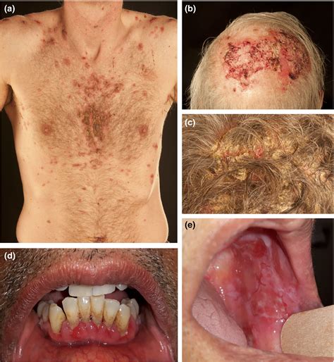 Pemphigus Vulgaris Oral Lesions
