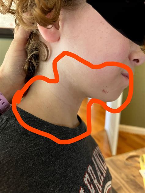 Discoloration over large section of skin : r/DermatologyQuestions