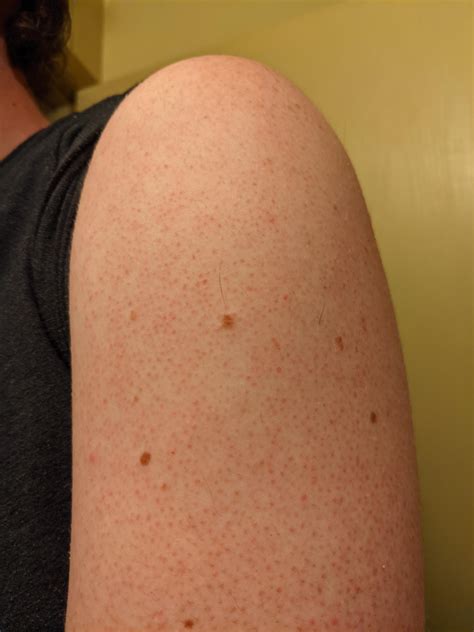 Red Bumps On Arm Meaning at Willian Meier blog