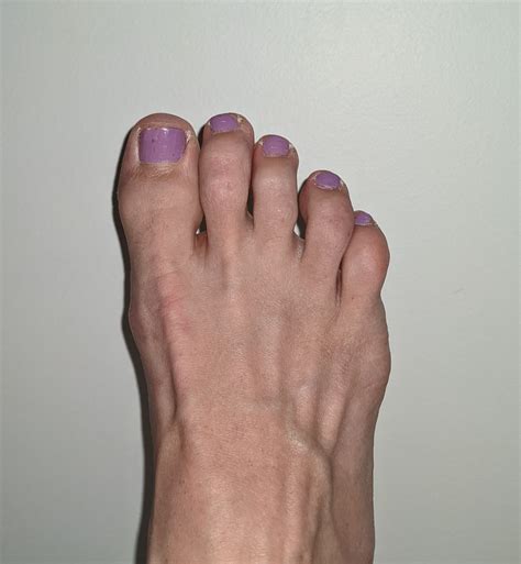 Do these look like tailor's bunions to you? : r/bunions