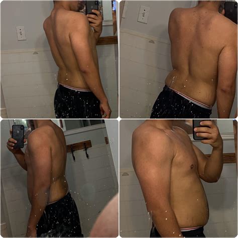 Not sure what is going on with these bones sticking out on my shoulder